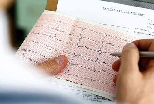 ECG image 3