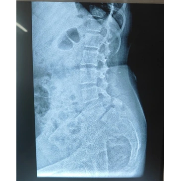 Spine pain evaluation