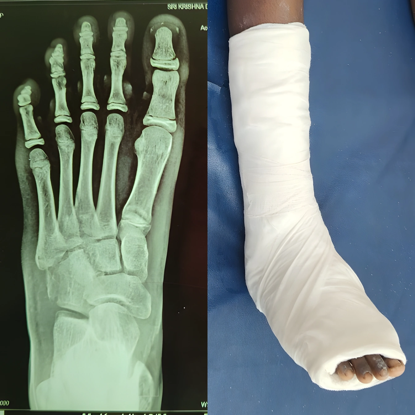 Sports Injury Treatment